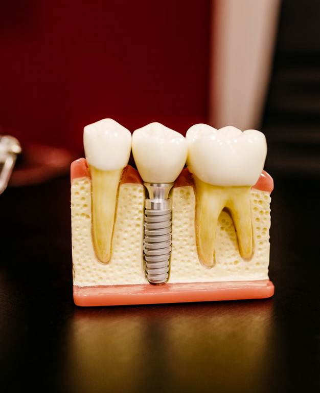 Implantes dentales en Bilbao